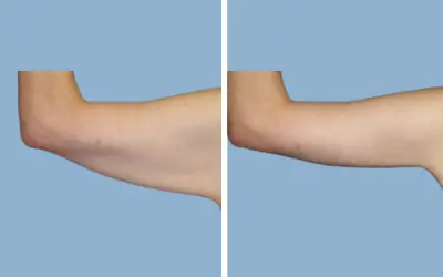 Before and After